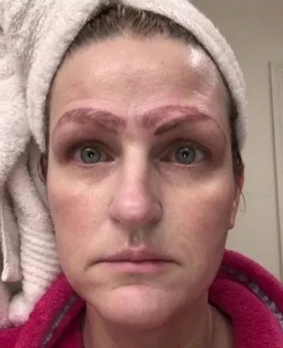 mujer quedó con cuatro cejas tras ofertón de micropigmentación