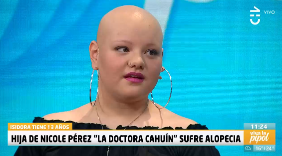 Nicole Pérez alopecia CHV viva la pipol