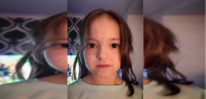 Niña se pintó manchas rojas para faltar al colegio por 