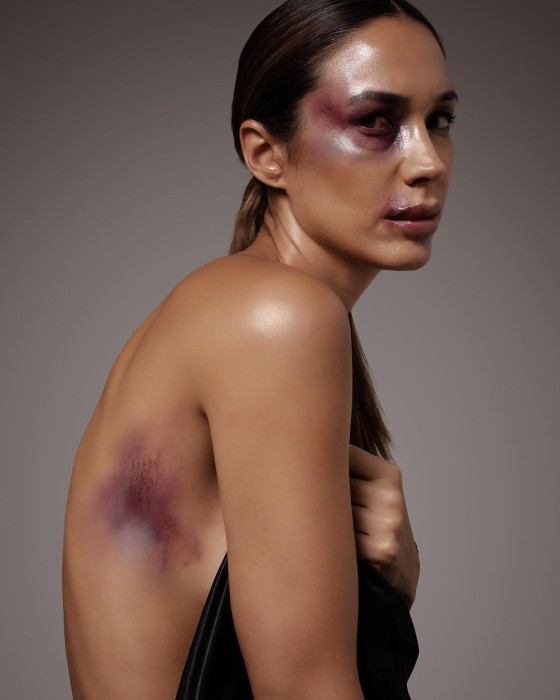 Vanesa Borghi impactó en redes con fotos con "moretones" y "heridas" para campaña contra el bullying