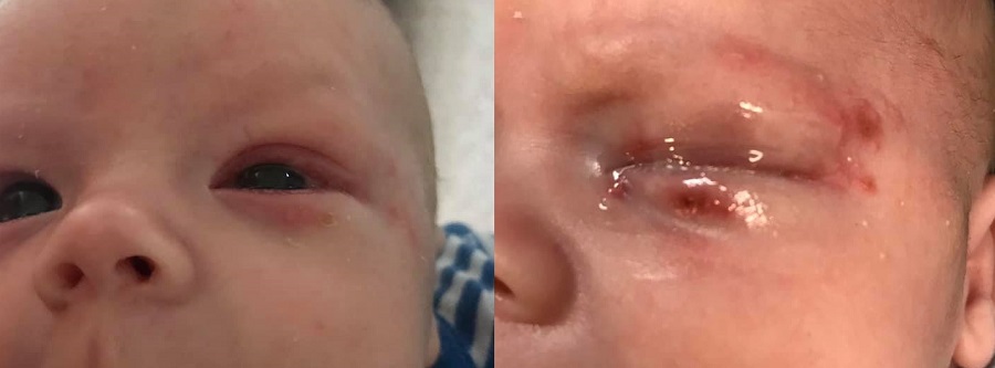 bebe recién nacido casi pierde un ojo tras recibir beso con herpes