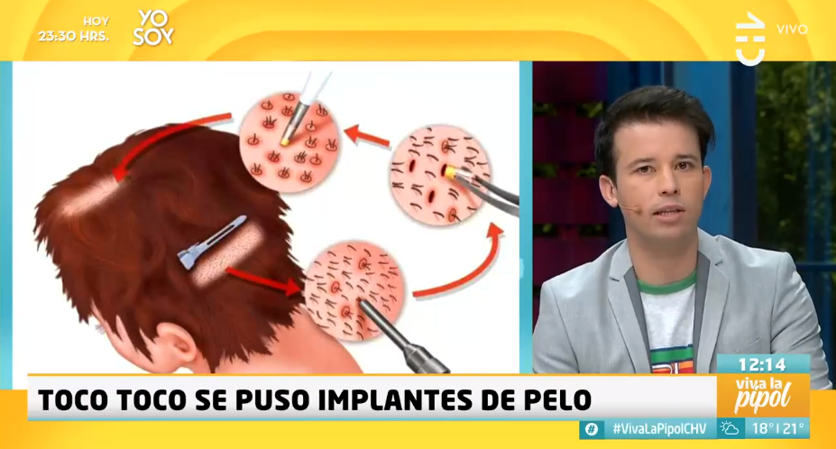 Luis Pedraza se sometió a implantes de pelo