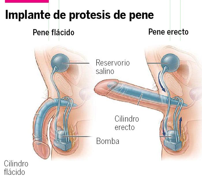 Mitos de la prótesis peneana