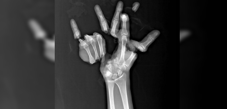 médico se demoró 13 horas en reconstruir una mano totalmente triturada