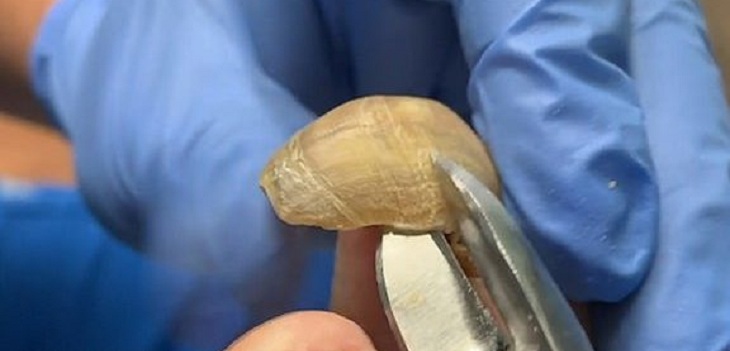 Mujer dejó crecer sus uñas de los pies por un año: médico documentó cómo logró cortarlas