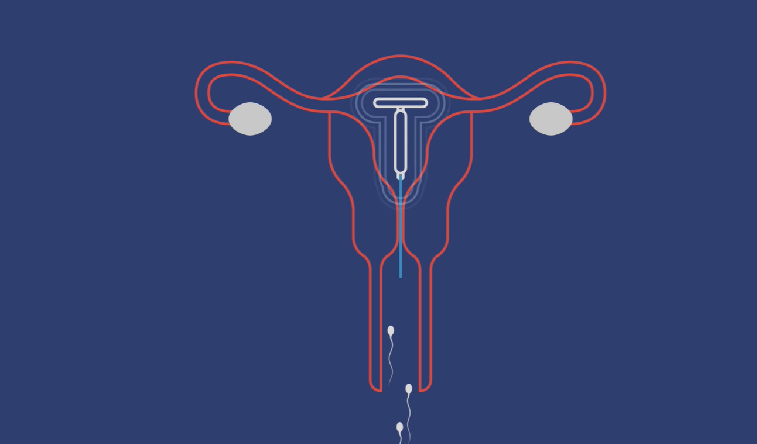 El método anticonceptivo más efectivo: La T de cobre