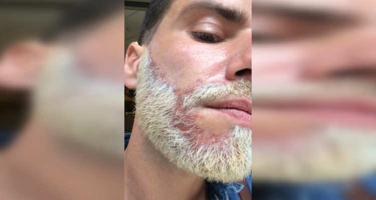 Hombre acusa a popular peluquería de quemarle la cara tras participar de 