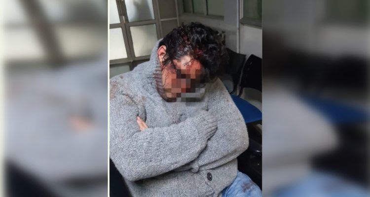 Chofer de Uber sufrió brutal golpiza en Valparaíso: se negó a llevar a 8 pasajeros tras fiesta