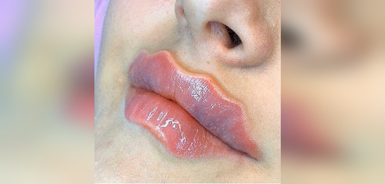 Devil lips la nueva tendencia de botox en los labios