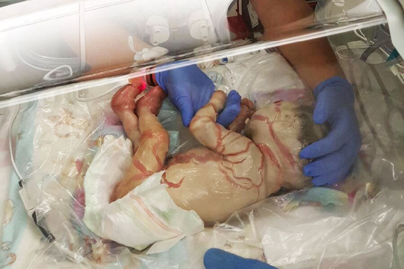 Niña nacida con una afección de la piel que la cubre con escamas desafió las probabilidades