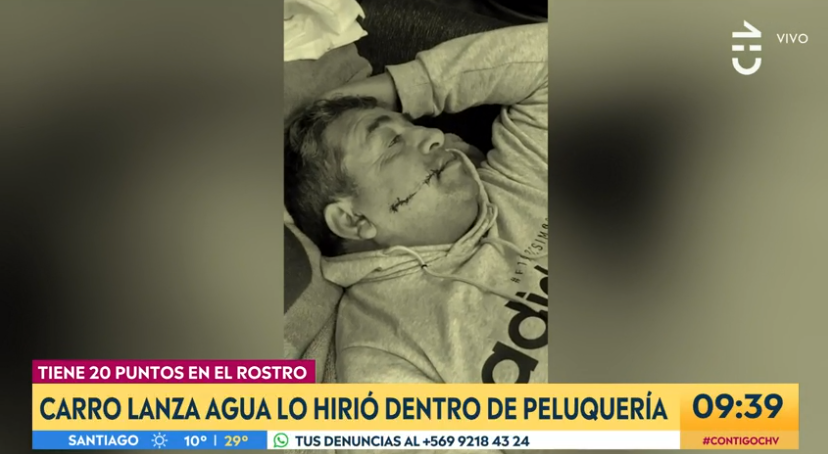 Hombre terminó con 20 puntos en su cara por ataque de carro lanza aguas