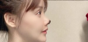 Actriz Gao Liu perdió parte de su nariz tras cirugía estética: mostró imágenes para advertir riesgos