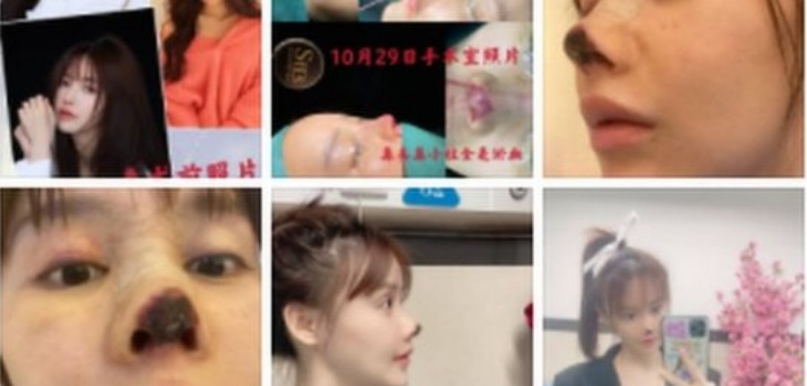 Actriz china pierde parte de su nariz tras cirugía estética