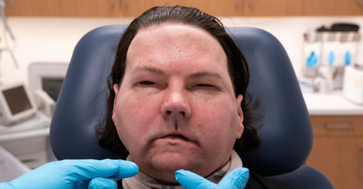 Víctima de accidente de coche recibe primer trasplante de cara y manos en EEUU