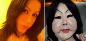 Mujer se inyectó silicona industrial y su cara se desfiguró: 