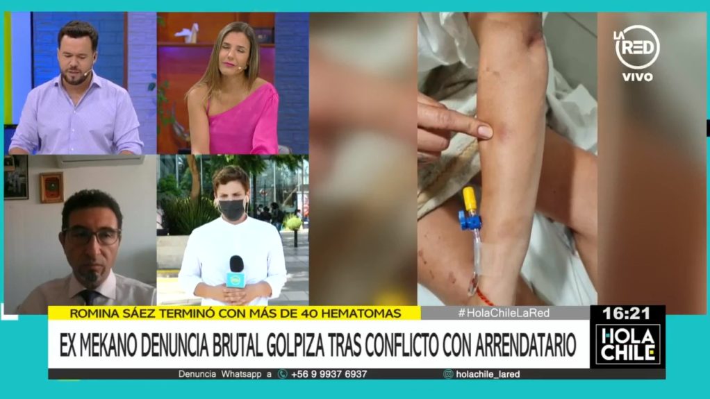 Familia de ex Mekano Romina Sáez acusó que fue víctima de brutal golpiza: recibió golpe con un bate