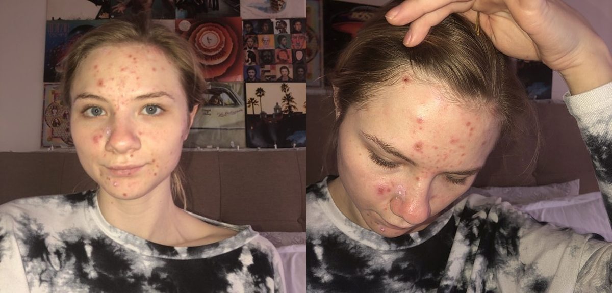 Joven se pellizca el rostro debido a doloroso trastorno compulsivo: escondió heridas por 10 años