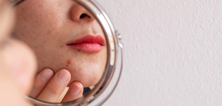 ¿Cómo eliminar el acné de la cara? Especialista da consejos y tratamiento a seguir