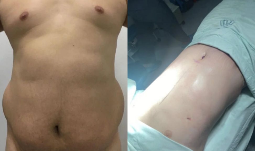 Ariel Osses mostró el antes y después de su operación