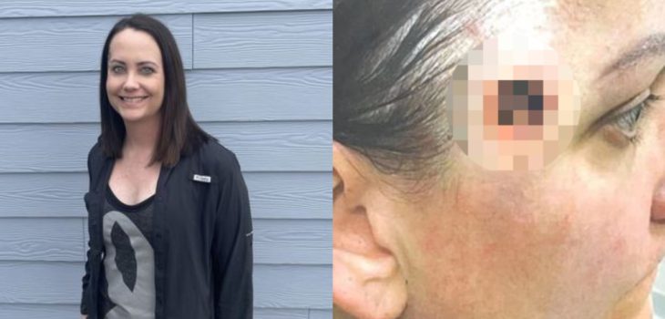Mujer terminó con un hoyo en la cabeza por abusar del solarium