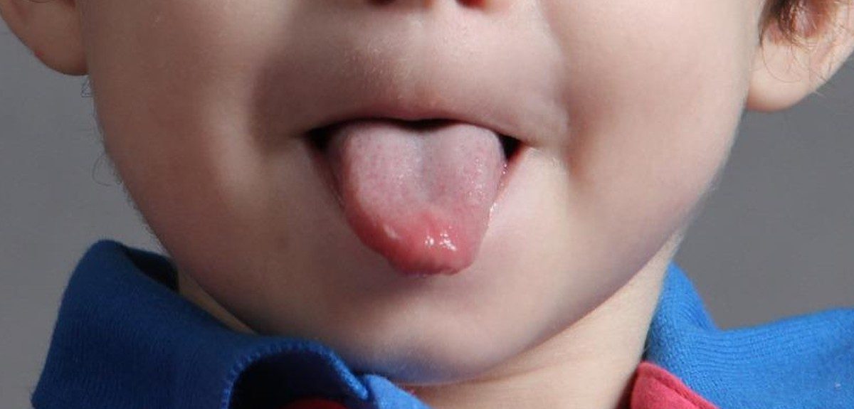 Los síntomas a los que debes estar atento para detectar un cáncer de lengua 