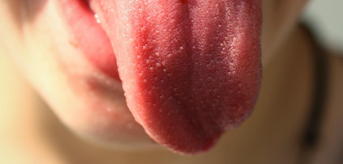 Los síntomas a los que debes estar atento para detectar un cáncer de lengua
