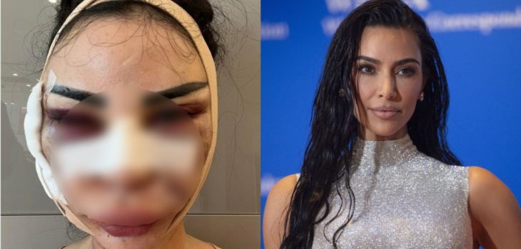 Mujer pagó 600 millones de pesos para parecerse a Kim Kardashian