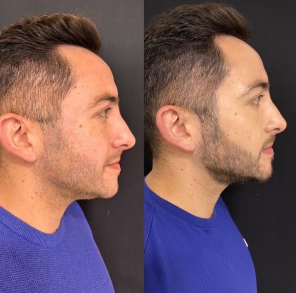 Perfilamiento mandibular, la tendencia a la que se sometió Hugo Valencia: este su antes y después
