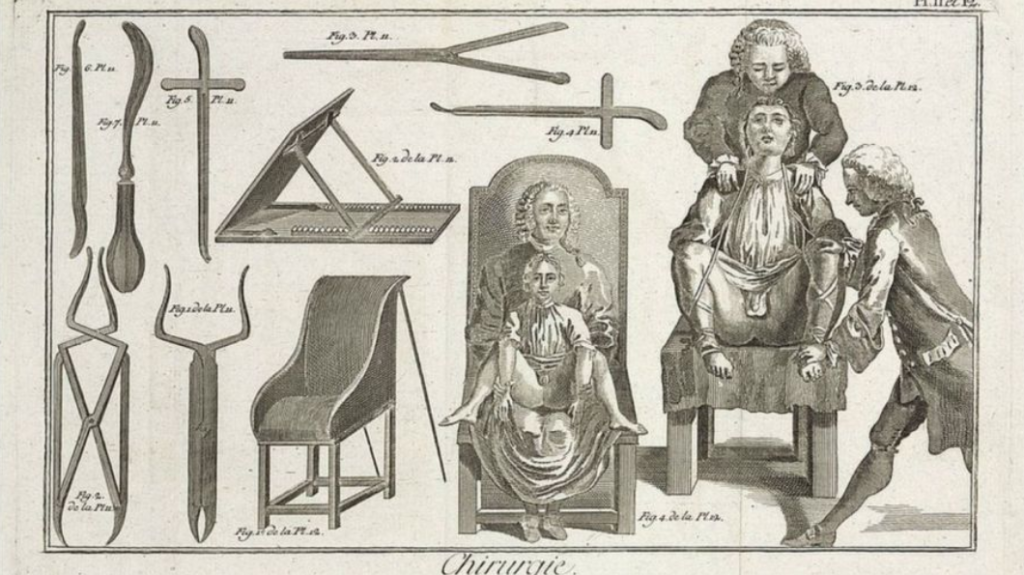 El día que el rey Luis XIV puso de moda las cirugías anales en toda Francia