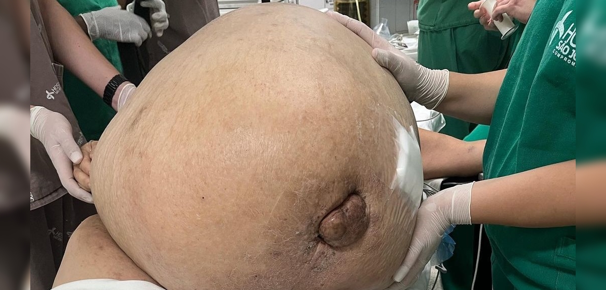 Equipo médico extirpó tumor de 46 kilos a mujer en Brasil: debió ser operada de urgencia