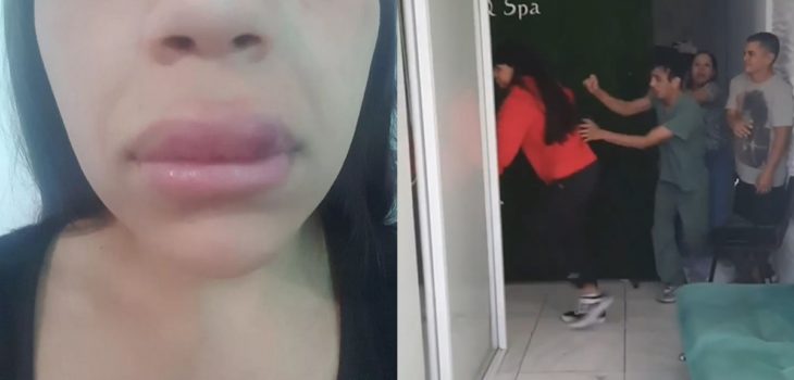 Insólito: a joven argentina le inyectaron dudoso líquido en los labios, reclamó y recibió golpiza