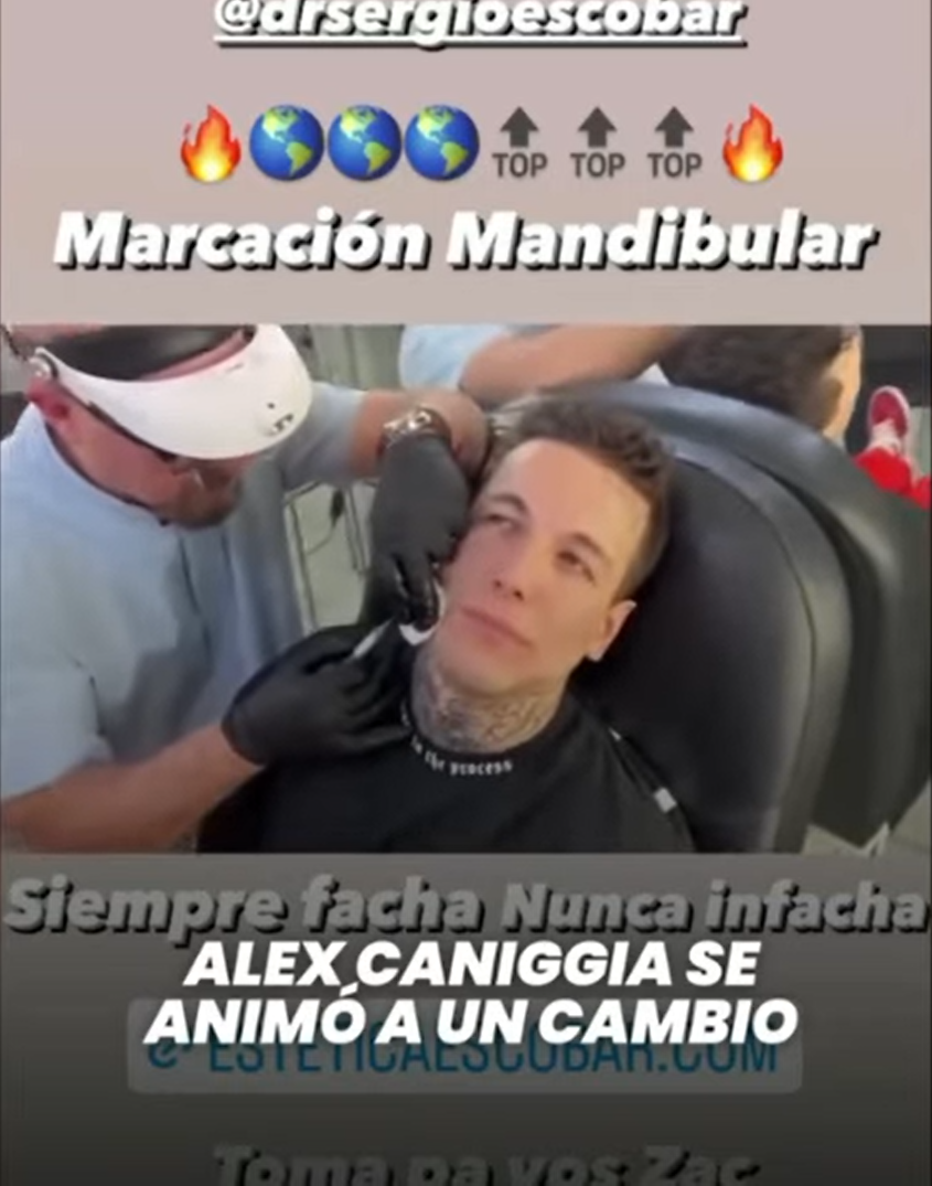 Ex Resistiré Álex Caniggia se sometió a retoque estético en su mandíbula y así quedó su rostro