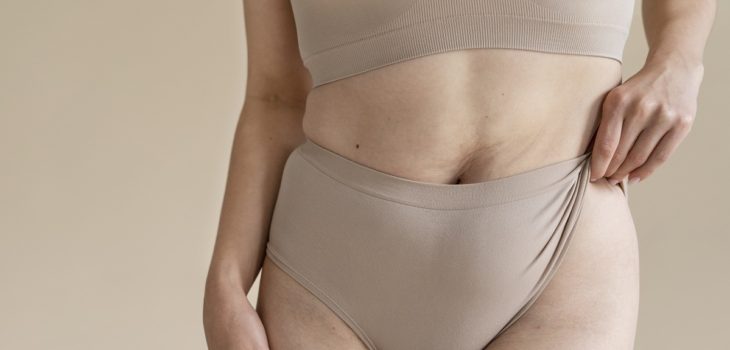 Lipedema: la enfermedad que afecta mayoritariamente a mujeres con grasa en brazos y piernas