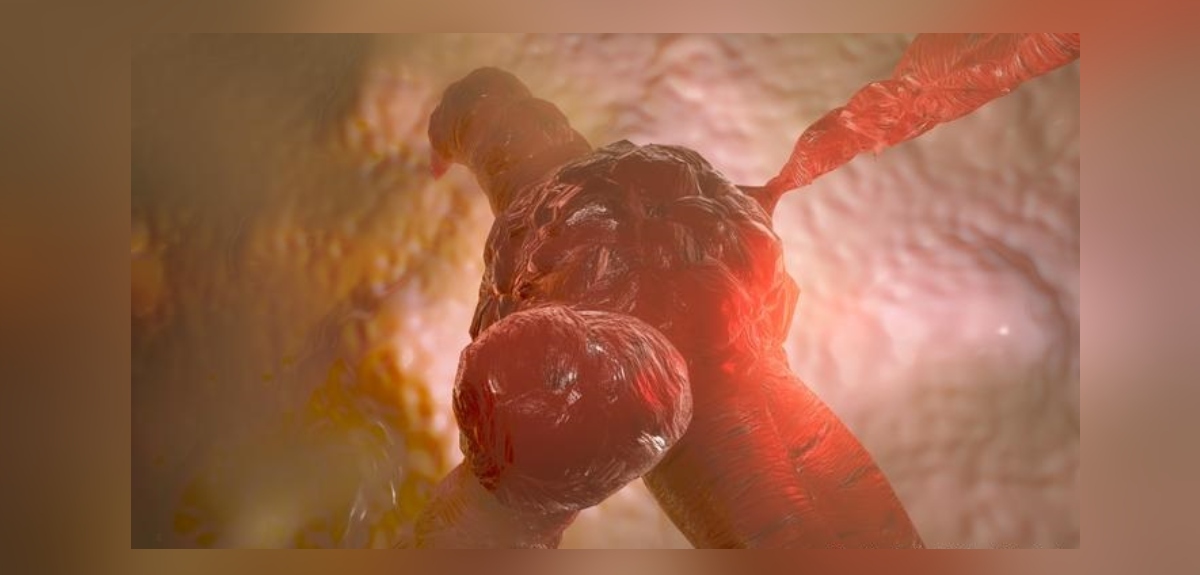 Descubren las células malignas responsables de la recaída en el cáncer de colon