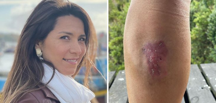 Loreto Aravena recuperación araña rincón