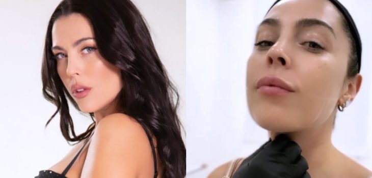 Daniela Aránguiz se sometió a cirugía plástica en su rostro y mostró resultado en videos: 