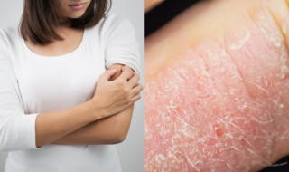 Dermatitis Atópica en la piel