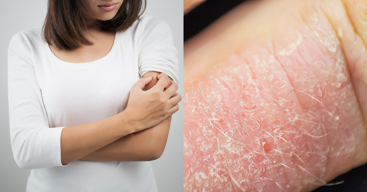 Dermatitis Atópica en la piel