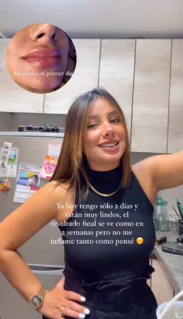 Actriz Nathalie Vera mostró perfilado de labios con ácido hialurónico