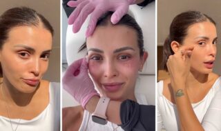 Cony Capelli contó procedimiento estético para ojeras con ADN de salmón