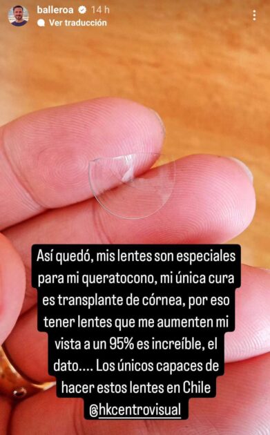 Álvaro Ballero sufre de queratocono y rompió lente de contacto