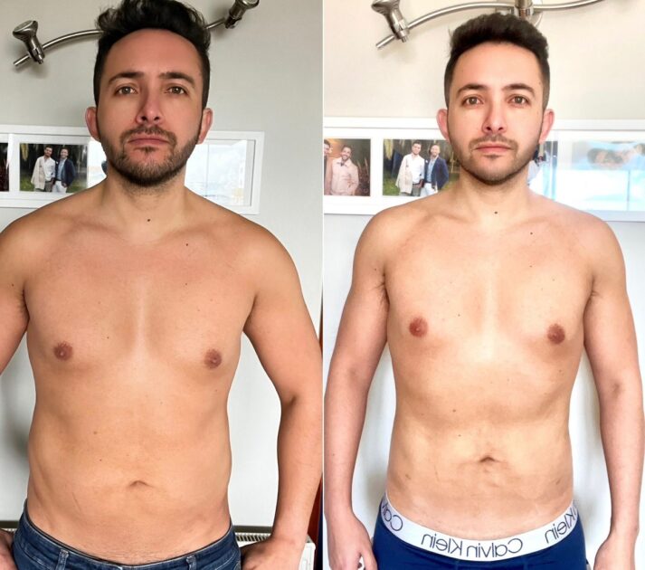 Hugo Valencia dio detalles de su recuperación tras lipo abdominal