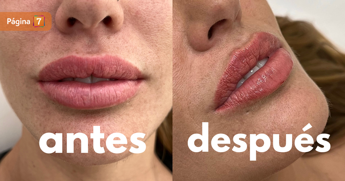 Gala Caldirola mostró radical antes y después de retoque estético: "Tenía los labios como salchicha"