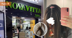 No busco lástima joven que sufrió quemadura en peluquería de Quilpué no podrá recuperar su pelo