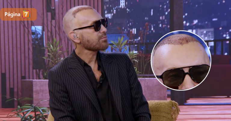 Jordi Castell explicó su curioso look tras cirugía de implante de pelo: 