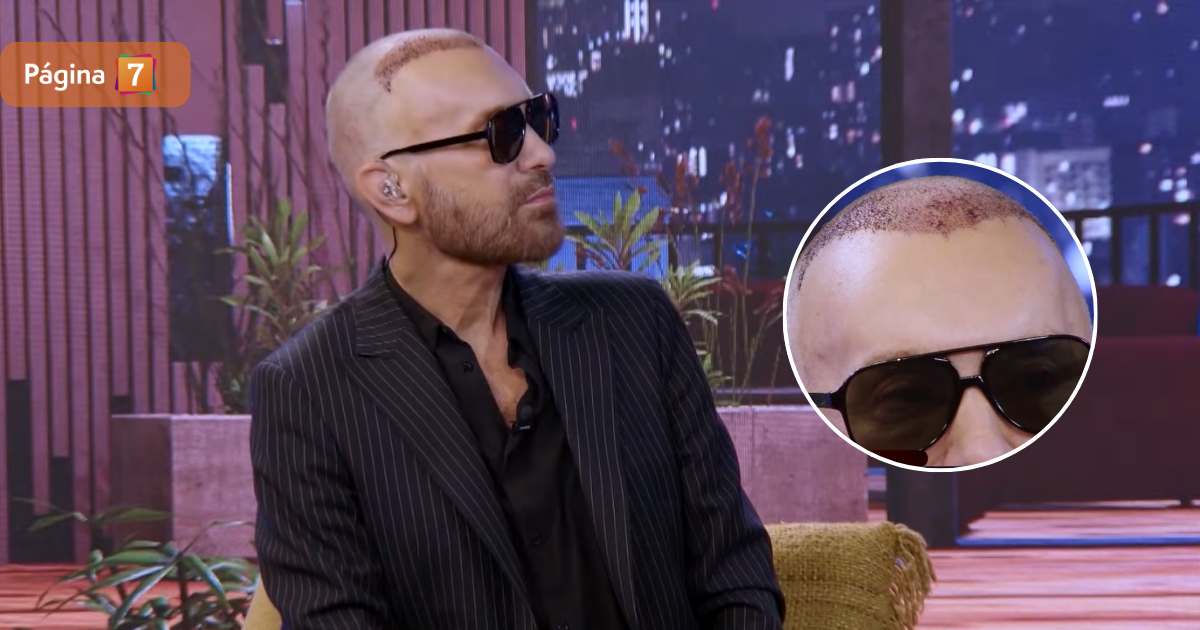 Jordi Castell explicó su curioso look tras cirugía de implante de pelo