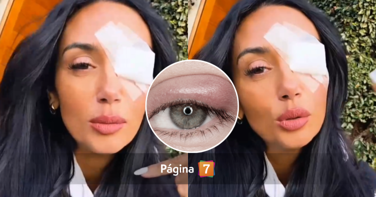 ¿Qué es un chalazión? La afección ocular que llevó a Pamela Díaz al quirófano