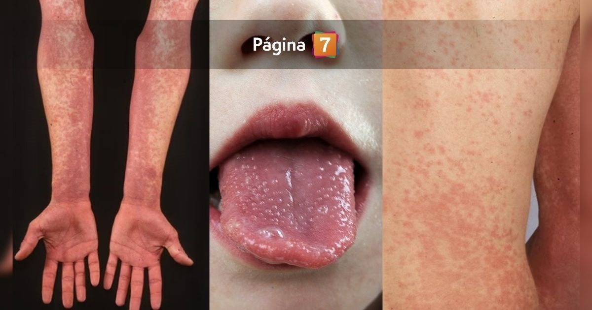 Confirman cinco casos de fiebre escarlatina en Talca: ¿qué es y cómo se contagia?