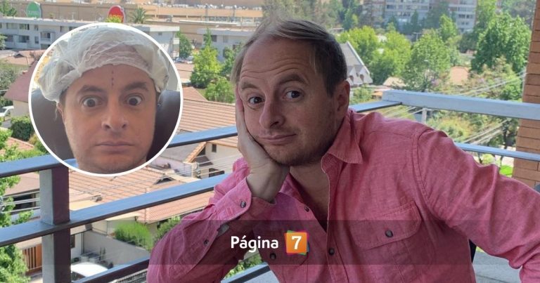 El radical cambio de Coke Hevia tras cirugía de implante capilar: “Este era yo sin pelo”