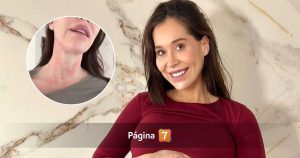 ¿Qué le pasó en el cuello? Vale Roth explicó las posibles razones de su urticaria
